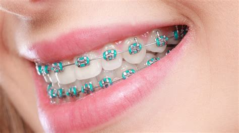 metal orthodontic bracket|pictures of traditional steel braces.